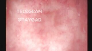 Bệnh Hoạn Nhật-Đổ Cá Vào Lỗ Đít: Xem thêm trong phần mô tả